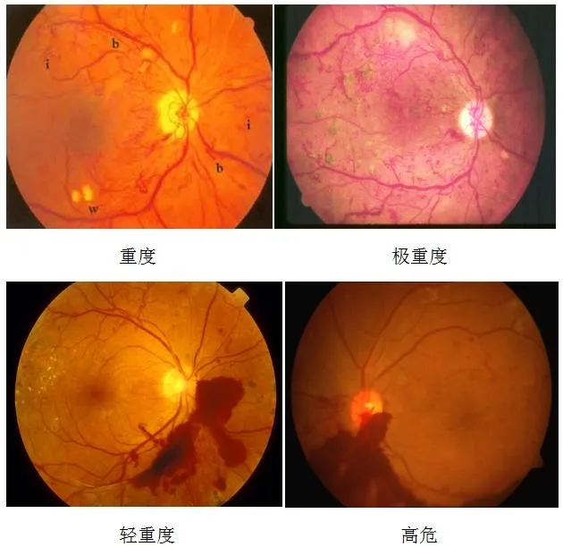 羟氯喹视网膜病变图片