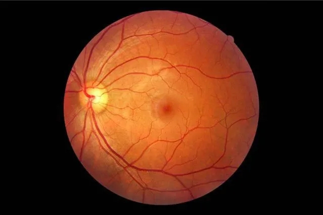 关于眼底黄斑病变你知道多少带你了解眼底黄斑病变